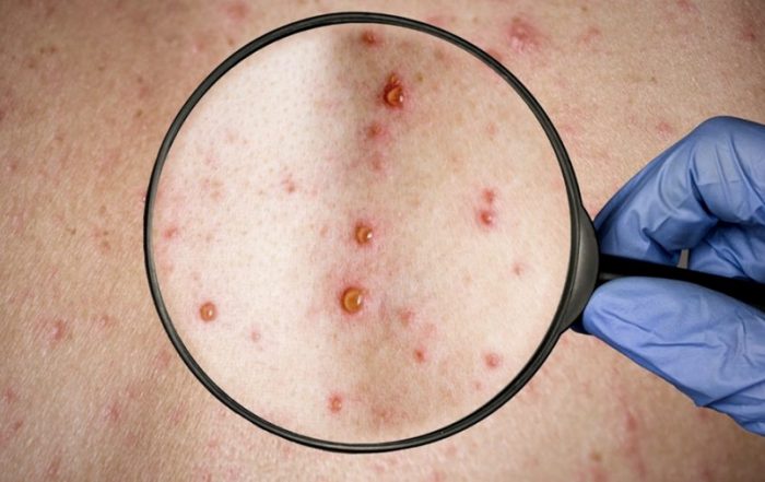 Caso viruela s&iacute;mica en la ciudad de Neiva