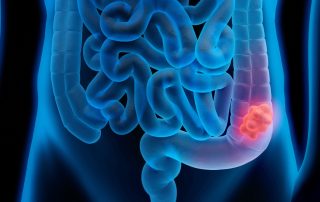Cáncer de colon