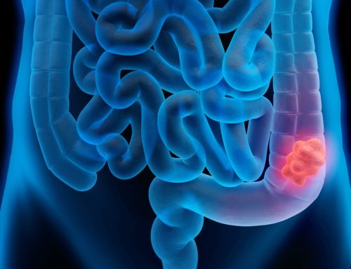 Conoce síntomas, estadísticas, acciones de prevención y más acerca del cáncer de colon