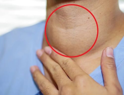 Lo que debes saber sobre el cáncer de tiroides